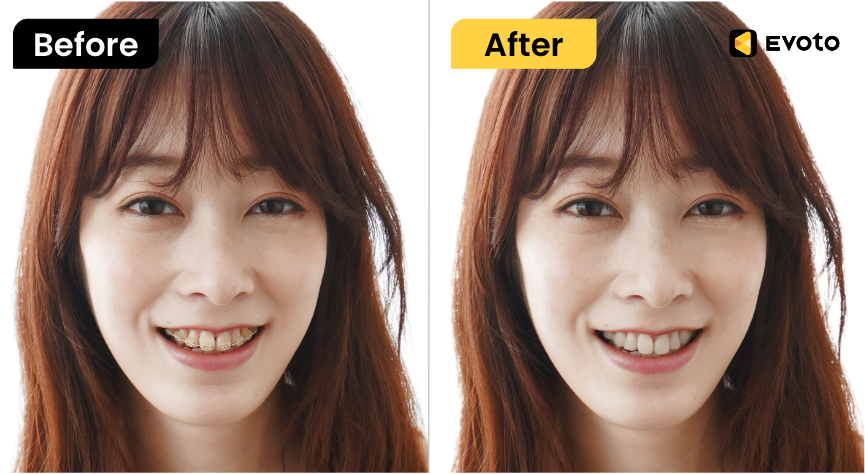 歯列矯正器具の除去機能（左：適応前・右：適用後）