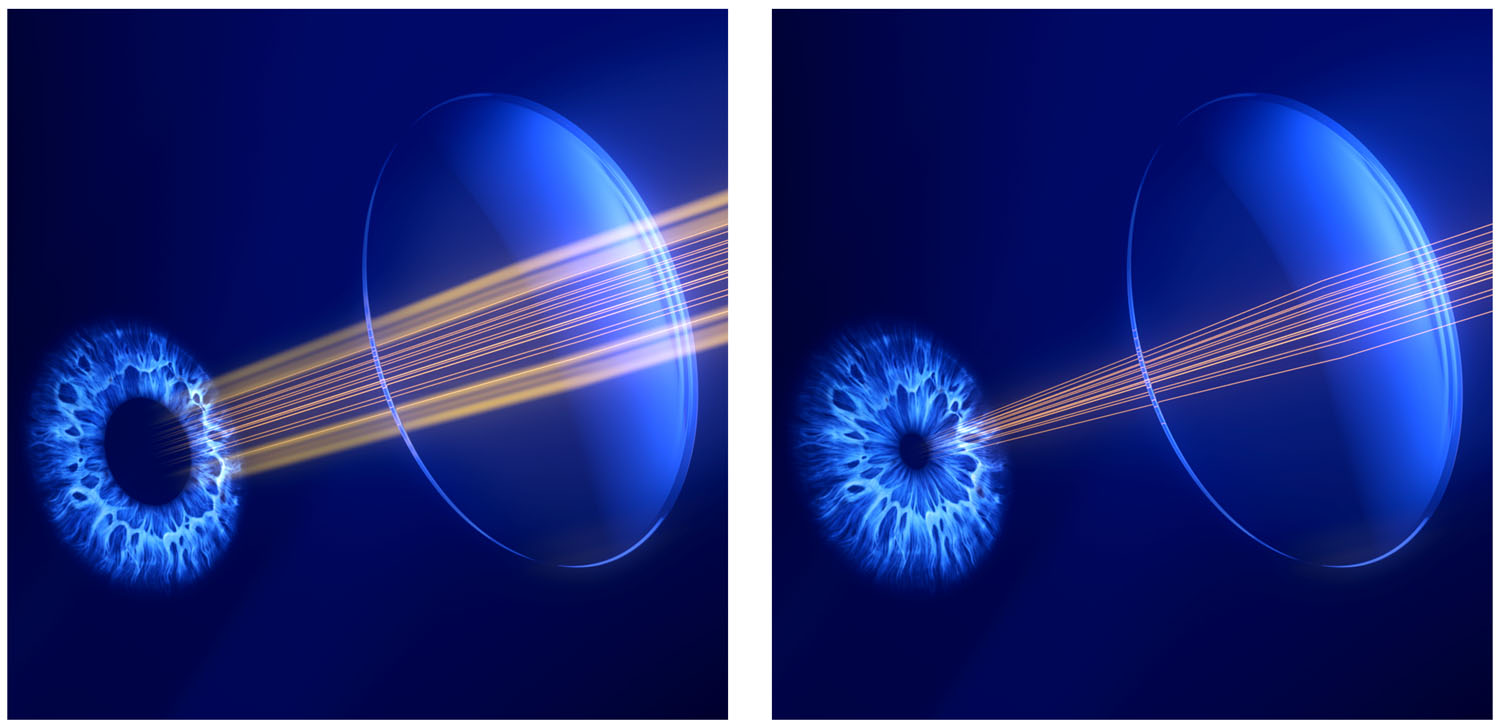瞳孔が開いたときに発生する収差が見えにくさの原因になっている