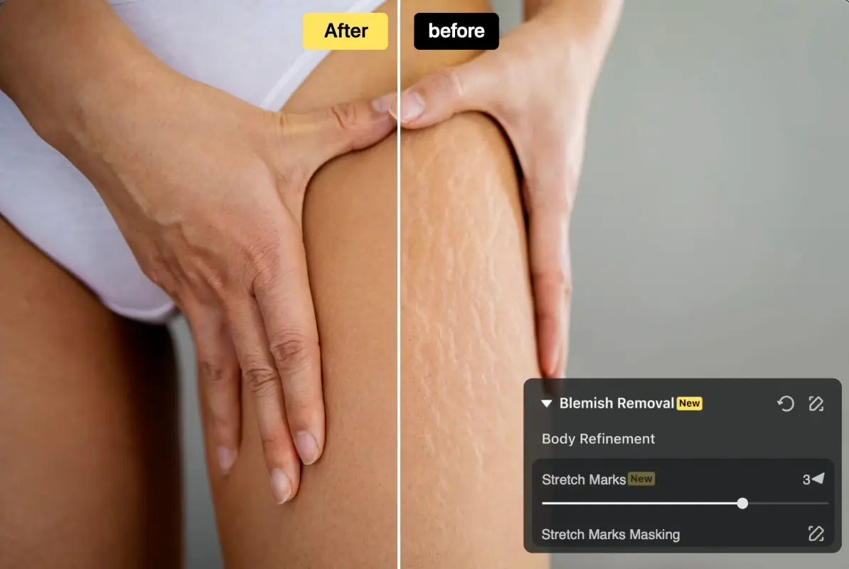 ストレッチマーク補正