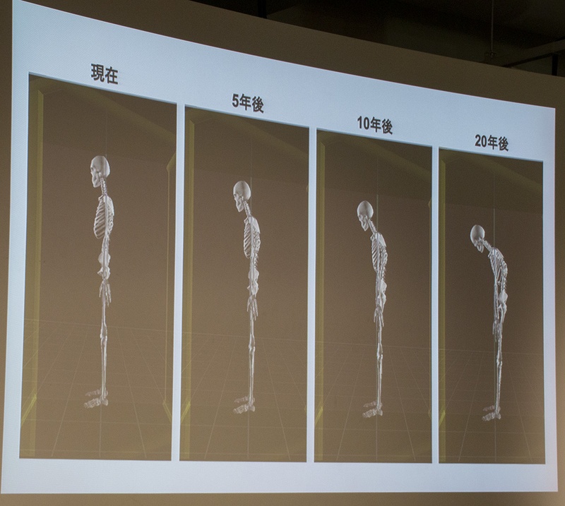 ノートパソコンで長時間デスクワークをしている患者(20代女性)の現在の姿勢から、20年後を予測した画像。20年後には首だけでなく、腰から前傾姿勢になっている。
