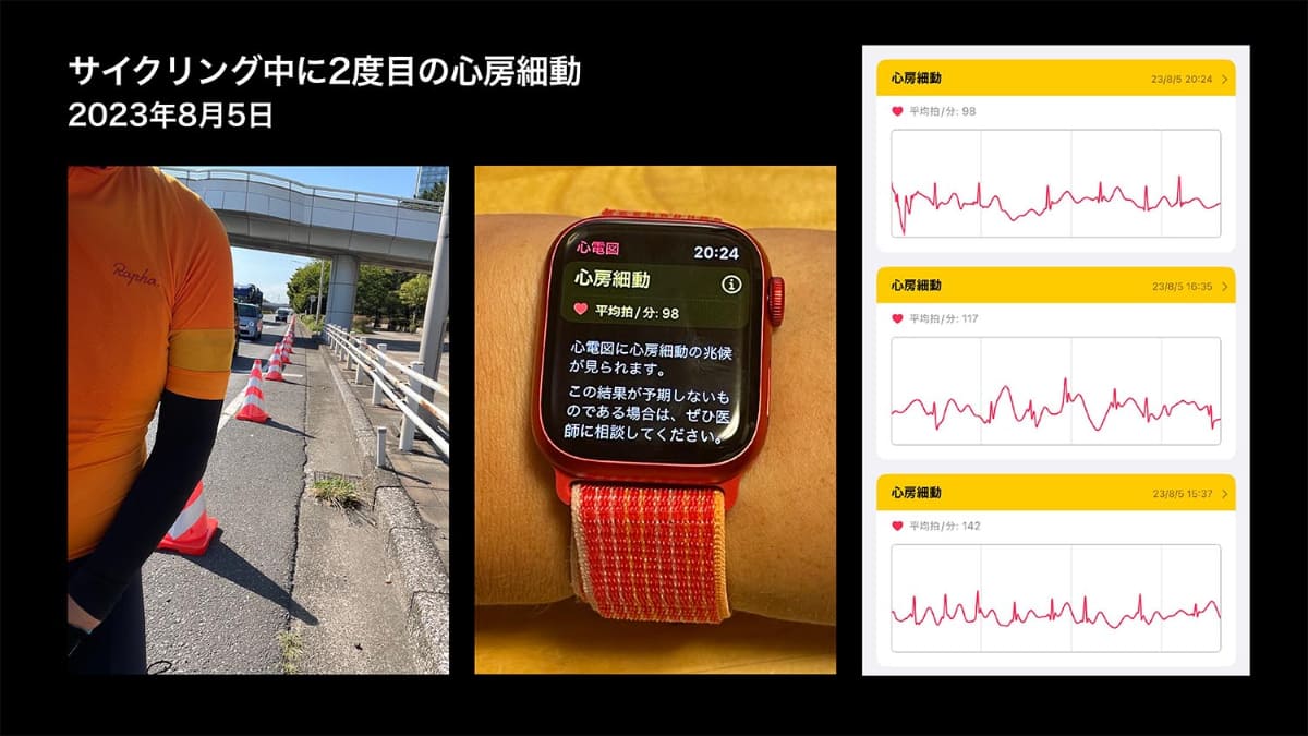 2度目の心房細動