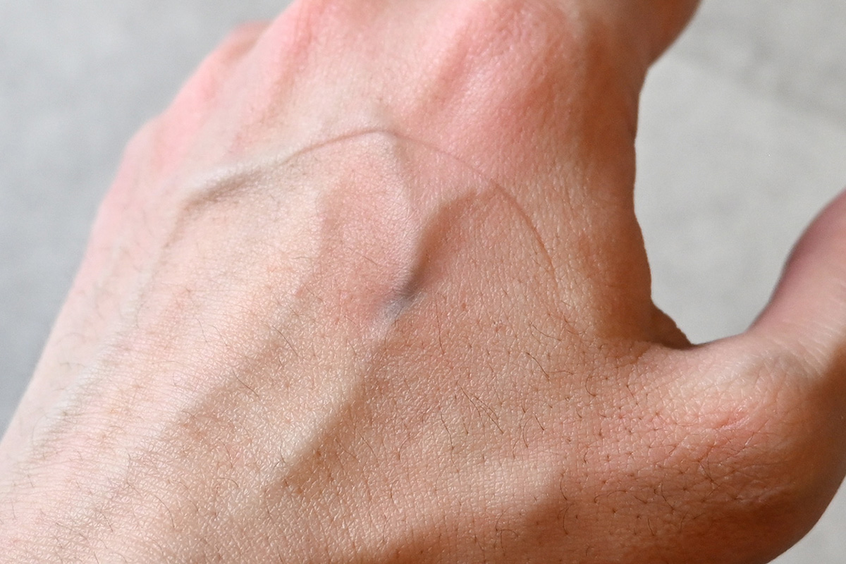 手の甲側はちょっと青くなったが、時間が経つと引いていった