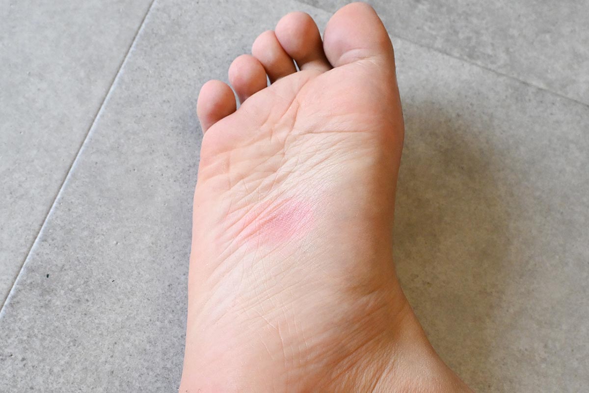靴下がある分だけ刺激は少ないはずだが、はっきりとツボ押しの跡が残った