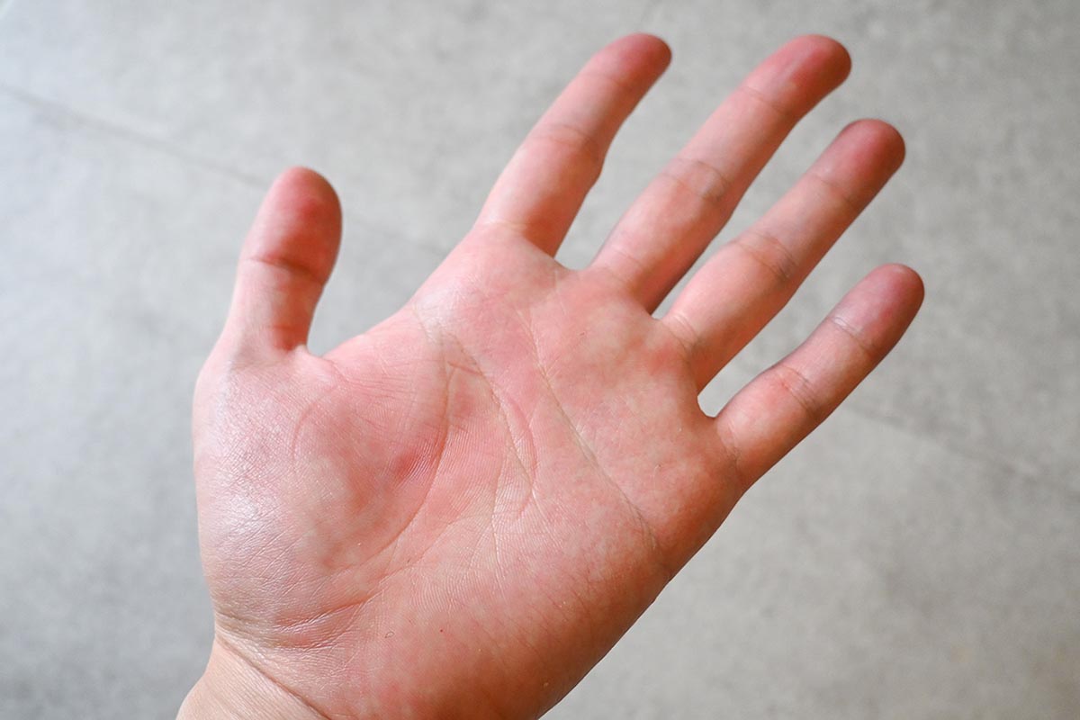「ゴリラの握手」を外すと、手のひらの血流が良くなったのか赤くなり、またツボが押された跡がしっかり残っている