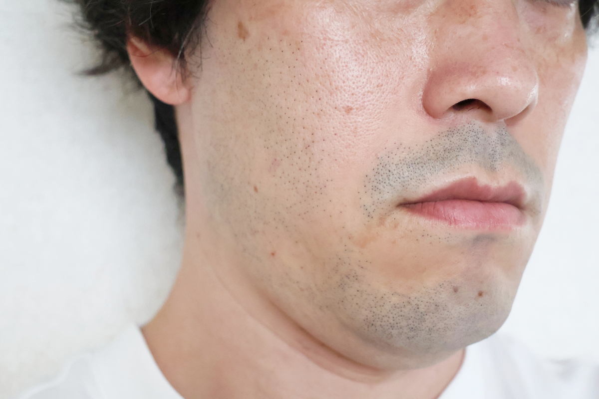 剃ったあと。もとがかなり濃いので多少色は残ります