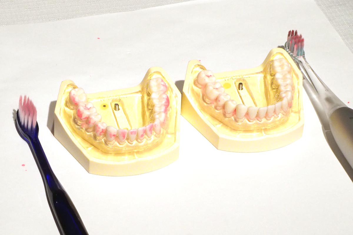 手磨きと約30秒間のブラッシングで比較。左の手磨きの方は、強く力が入っているようにみえたが磨き残しは多かった