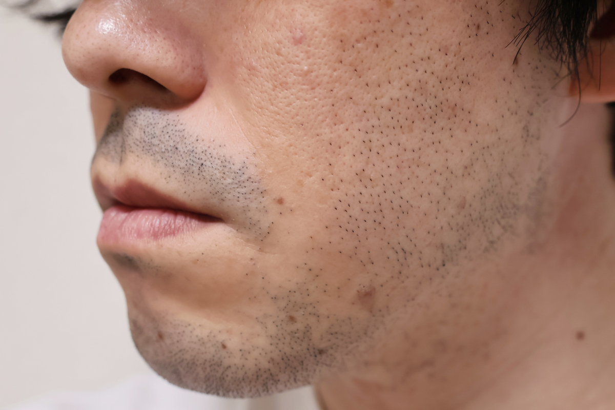 Befor。約1日伸びた毛