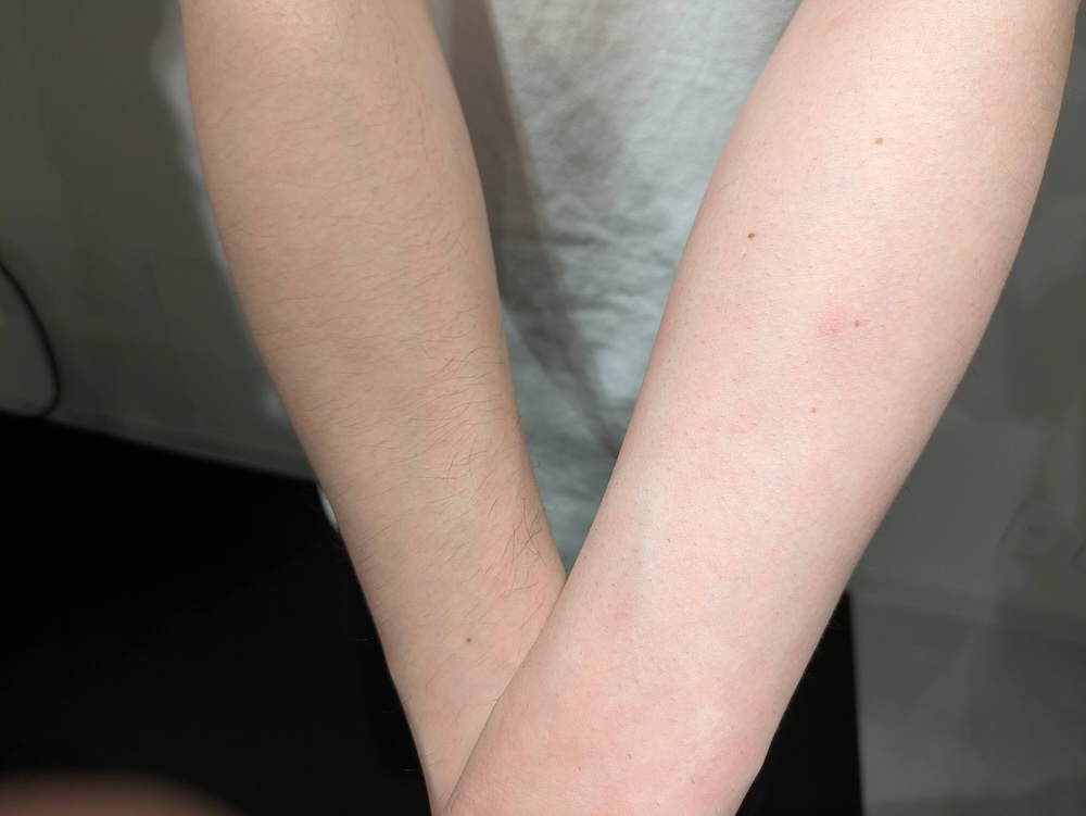 こちらも実演で剃った左腕と、剃っていない右腕