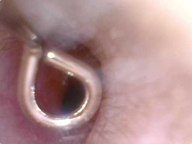 さらに奥へ。場合によってはLEDライト光量の調節をする必要もあります。右はいちばん奥のほう（届くところ）まで到達したもの。白っぽい耳垢が散見されます。奥にある白いものは恐らく鼓膜だと思います。