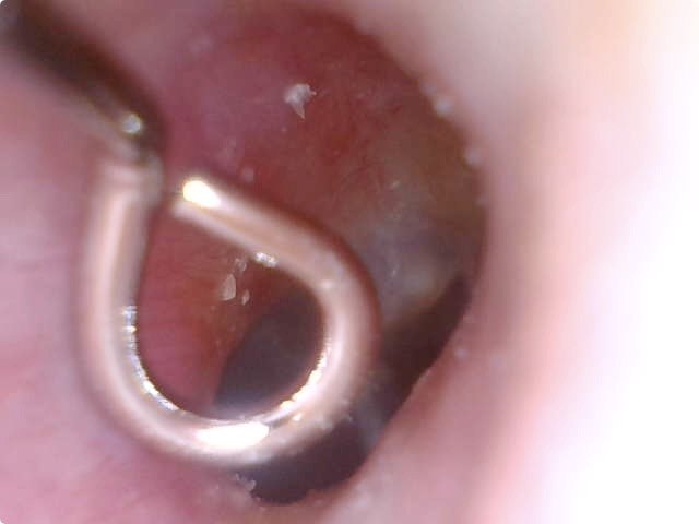 さらに奥へ。場合によってはLEDライト光量の調節をする必要もあります。右はいちばん奥のほう（届くところ）まで到達したもの。白っぽい耳垢が散見されます。奥にある白いものは恐らく鼓膜だと思います。