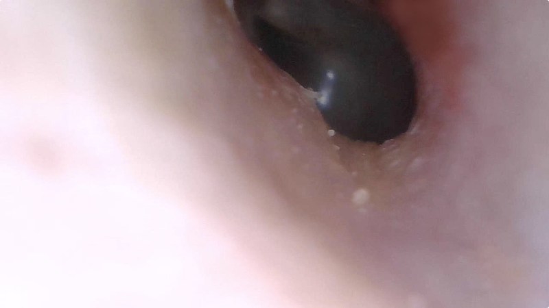 さらに奥へ。マイクロスコープ部分先端が（耳に入れるには）やや太めなので、鼓膜らしきものは見えるものの、鼓膜間近までは到達できませんでした。