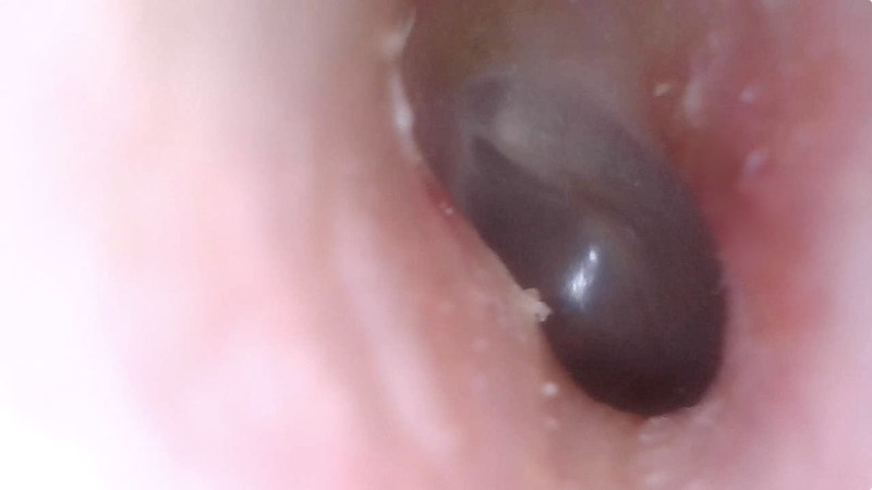 さらに奥へ。マイクロスコープ部分先端が（耳に入れるには）やや太めなので、鼓膜らしきものは見えるものの、鼓膜間近までは到達できませんでした。