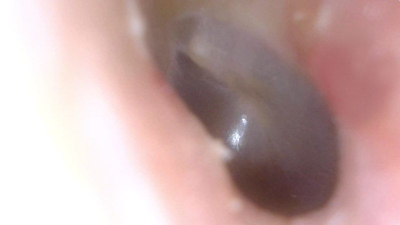 さらに奥へ。マイクロスコープ部分先端が（耳に入れるには）やや太めなので、鼓膜らしきものは見えるものの、鼓膜間近までは到達できませんでした。