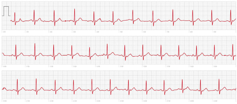 Apple Watchで測定・取得した心電図はiPhone上で詳細に確認できるほか、PDFファイルとして取り出すことができる。