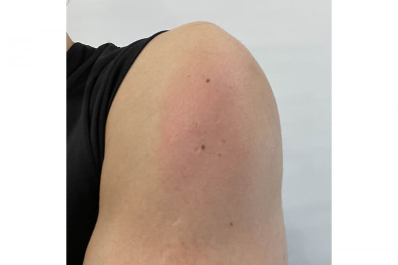 ワクチン接種後の肩。よーく見ると注射されたあたりが赤くなっている