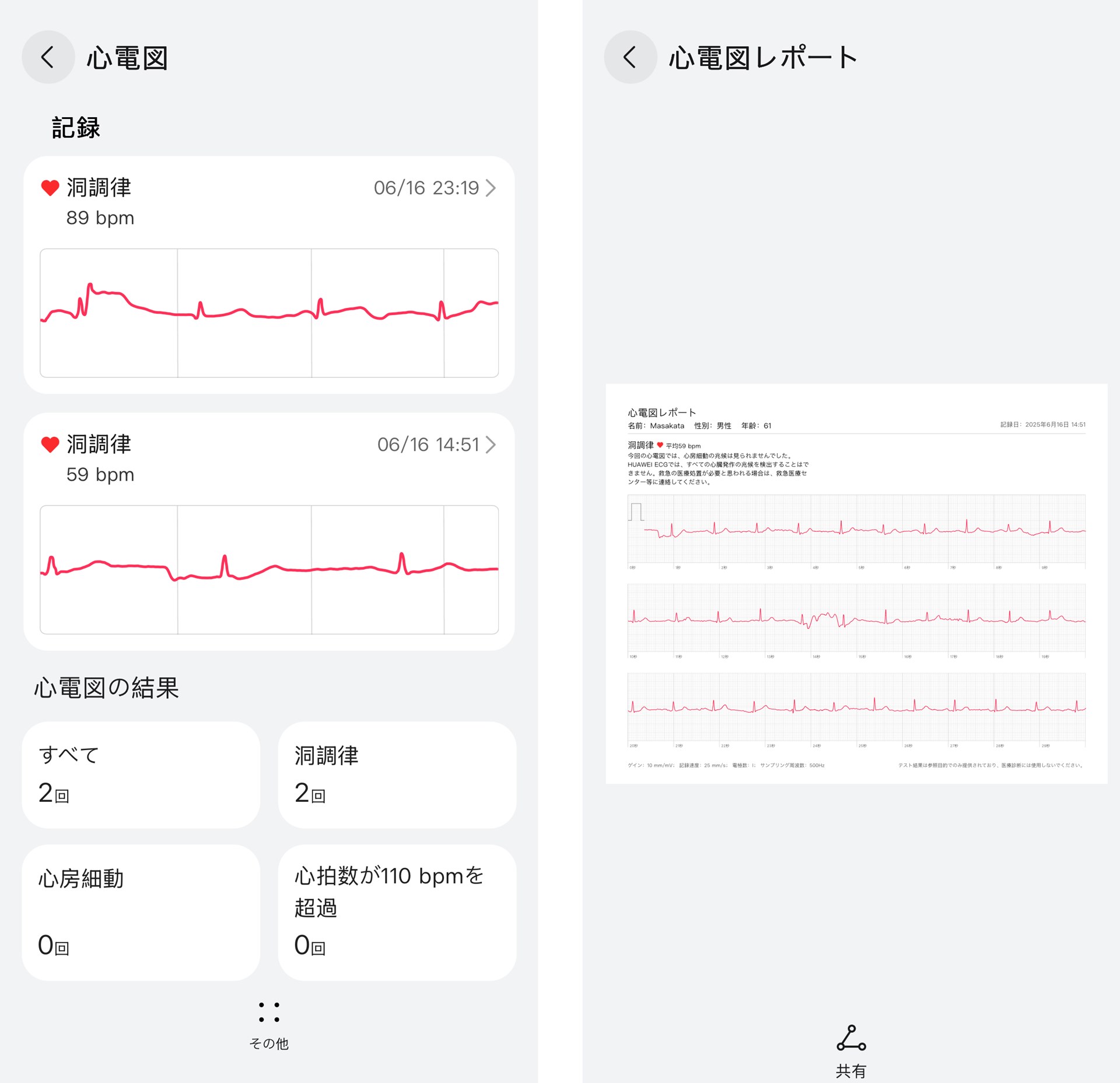 心電図の結果も「HUAWEI Health」アプリに蓄積されていく。PDFファイルにして共有したり、プリントして医師に見せたりすることも可能
