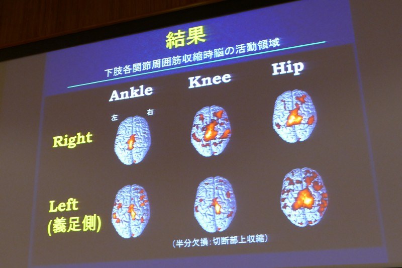 義足の走り高跳びの山本篤選手の脳