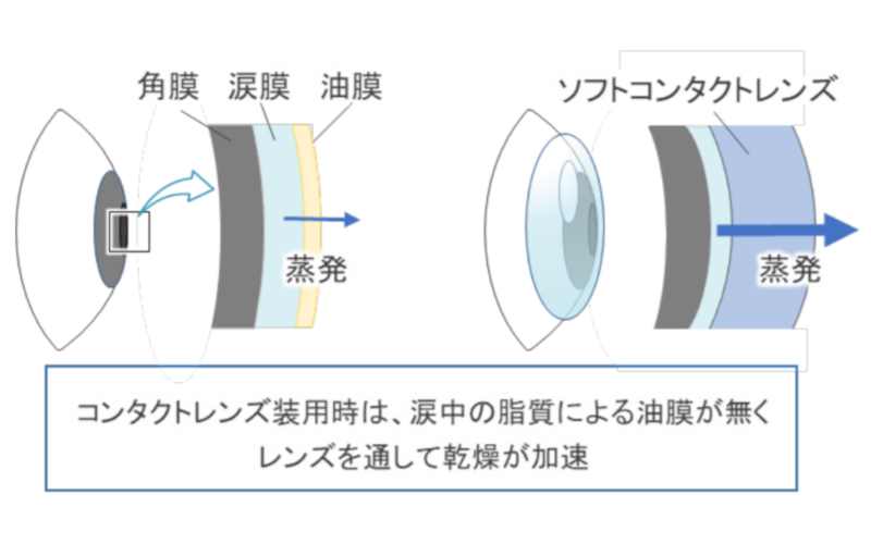 コンタクトレンズによるドライアイ