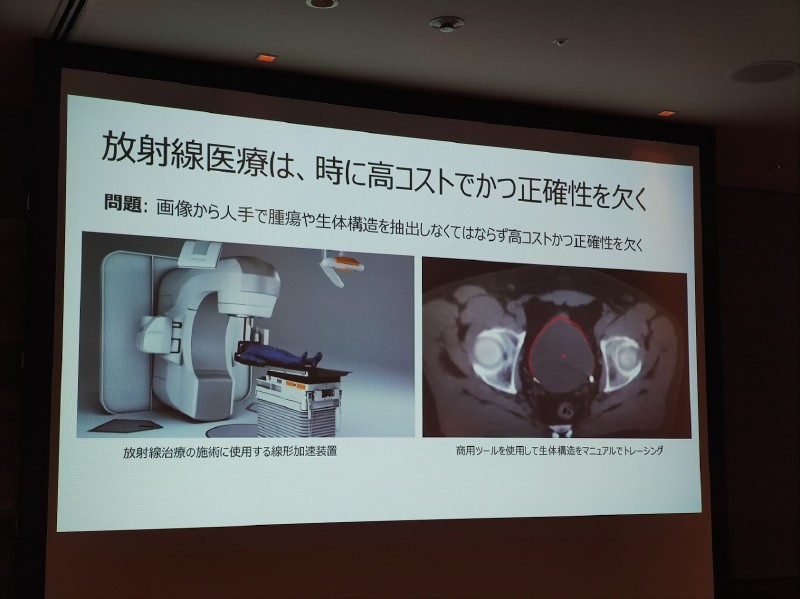 統計モデルを利用した放射線治療のサポート