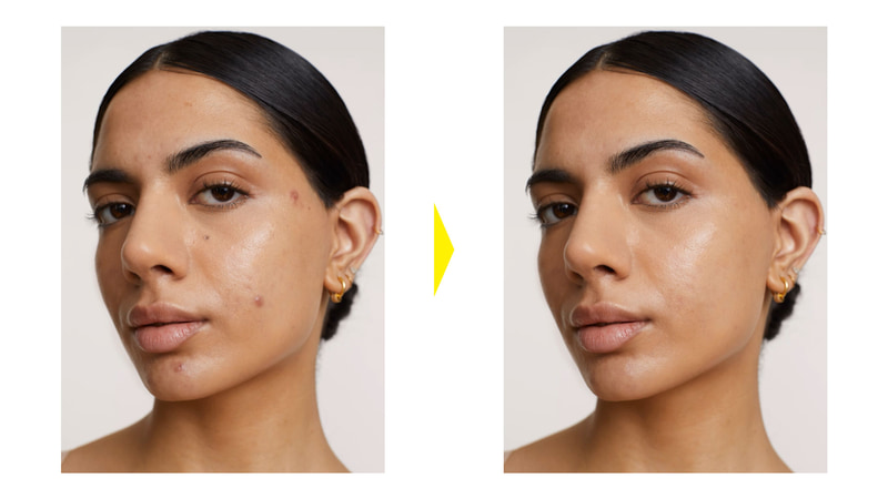 これらのツールを使い目立つニキビなどを除去したところです