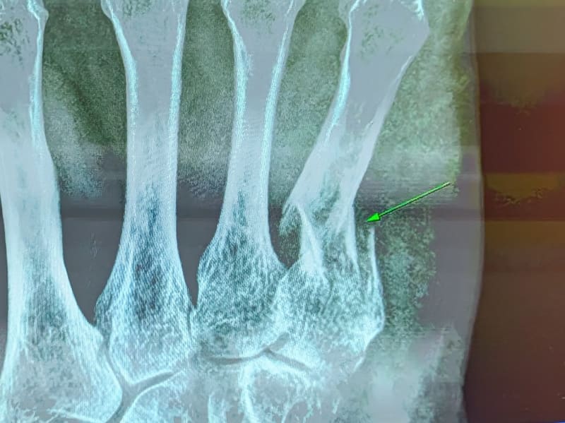 自身の骨折のレントゲン写真もプレゼンし、折れている個所を示して笑いを見せていた